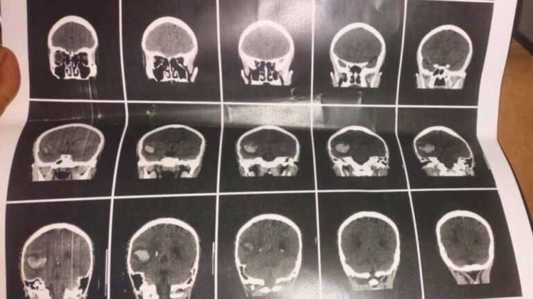 adolescente-de-13-anos-sofre-hemorragia-cerebral-apos-agressao-em-escola-estadual-de-birigui